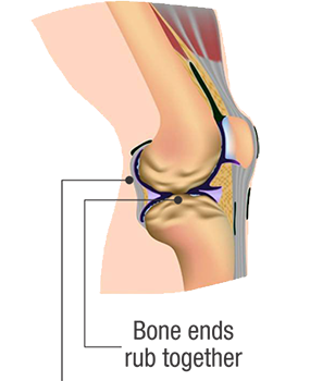 joint_diseases_osteoarthritis_pic2