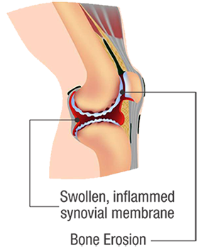 joint_diseases_rheumatoid_pic3